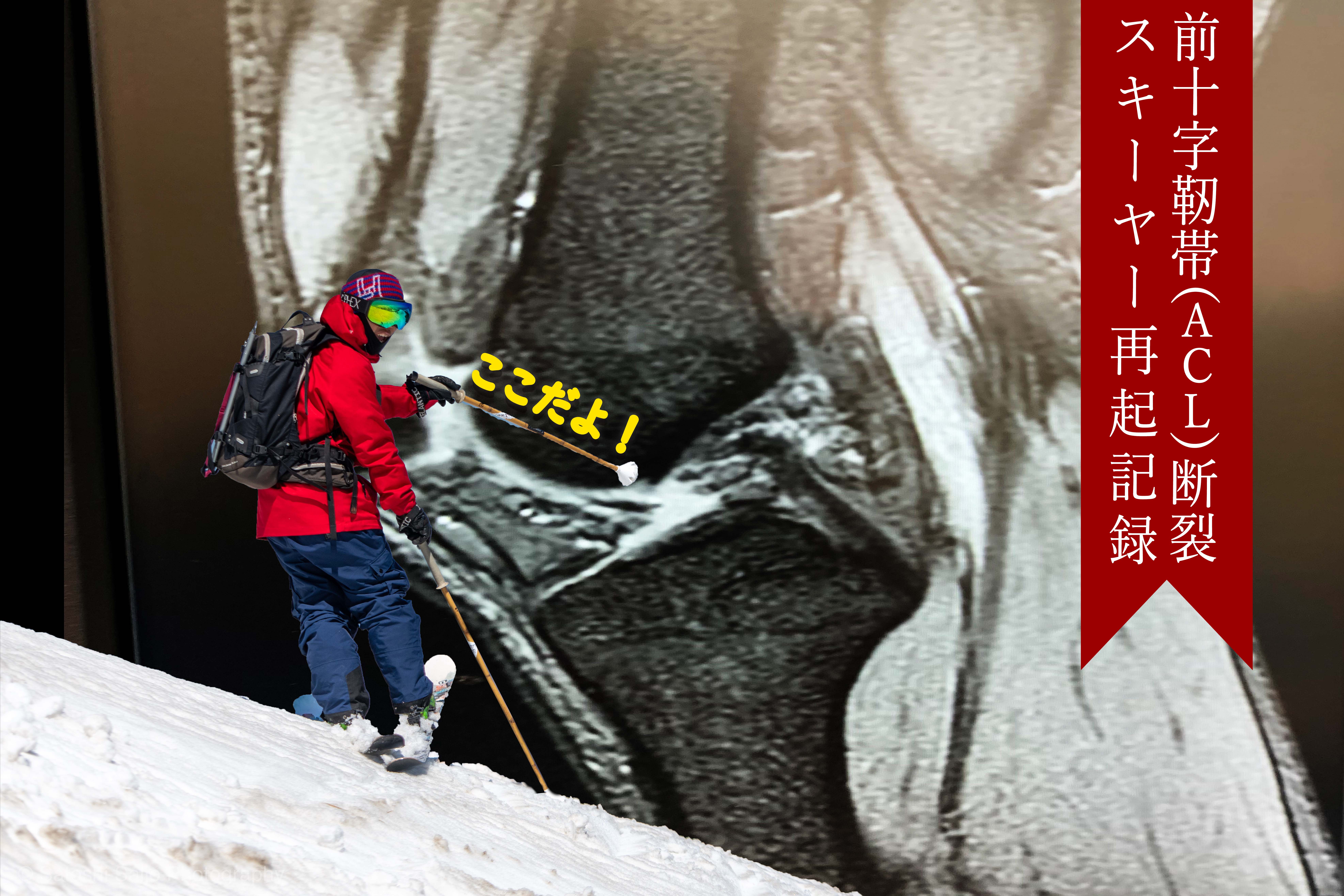 前十字靭帯断裂スキーヤー再起記録 Vol 1 前十字靭帯断裂 手術まで